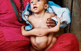 Em bé 8 chân tay gây xôn xao Nepal