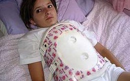 Cô bé 12 năm đeo "mai rùa"