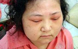 Hiểm họa khi lạm dụng "thuốc làm mập"