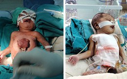 Cứu sống em bé có trái tim ngoài lồng ngực