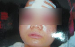 Đánh lún sọ, gãy răng hàng xóm, kẻ thủ ác vẫn... nhởn nhơ