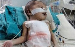 Em bé có trái tim ngoài lồng ngực đã tử vong