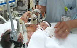 Tách hai bé gái dính ngược đầu