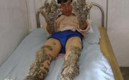 "Người cây"... lột xác