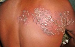 Viêm da do tiếp xúc côn trùng: Chậm điều trị dễ tai biến nặng