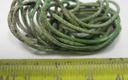 Cuộn dây điện 1,3 mét trong bàng quang cậu bé 14 tuổi