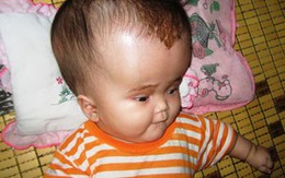 Bé gái chết mòn vì cái đầu khổng lồ