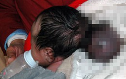 Em bé 2 đầu bị bỏ rơi