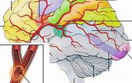 Cấp cứu tai biến mạch máu não bằng Đông y 