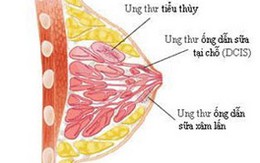 Phương pháp tái tạo mô tế bào ngực bị ung thư 