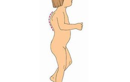 Phát hiện sớm bệnh gù lưng ở trẻ em 