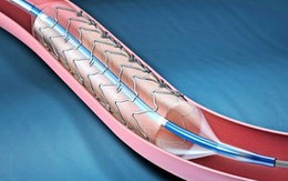 Đặt stent điều trị đột quỵ do tắc nghẽn động mạch 