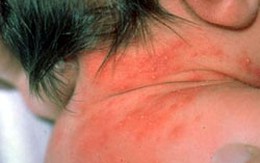 10 loại bệnh về da thường gặp