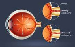 Đông y chữa teo thần kinh thị giác 