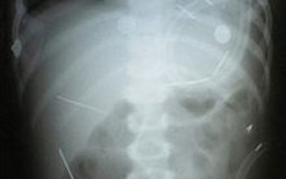 Bé trai 2 tuổi bị găm 50 cái kim vào người