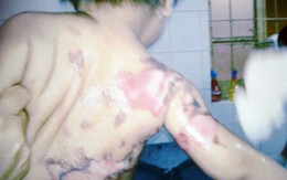 Bắt kẻ tạt nước sôi vào cháu nhỏ 