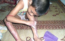 Đứa trẻ 11 tuổi bị tra khảo trên đống lửa