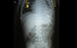 Cha dượng cắm 42 cây kim vào người bé 2 tuổi
