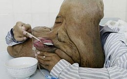 5 loại bệnh kỳ lạ tại châu Á