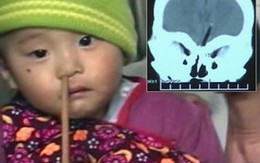 Bé trai 1 tuổi bị đũa xuyên thẳng từ mũi lên não