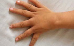 Bé gái có bàn tay 6 ngón gần giống hệt nhau