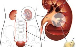 Một ca bệnh tự khỏi hiếm gặp trên thế giới ở Việt Nam