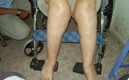 70 bệnh nhân nghèo được thay khớp gối miễn phí 