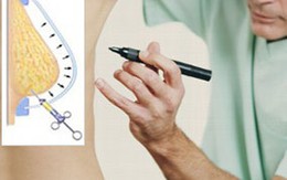 Cụ bà 75 "phục hồi" bộ ngực bị cắt vì ung thư