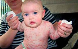 Bé 2 tuổi chiến đấu với bệnh "bỏng" toàn thân
