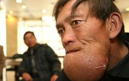 Người đàn ông có chiếc cằm to nhất thế giới