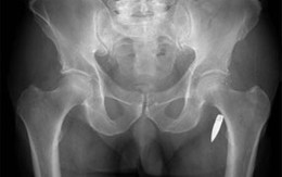 Đạn găm vào hông suốt 66 năm mà không biết