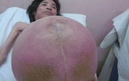 Người phụ nữ có khối u to như cái thúng trong bụng ở Thanh Hóa