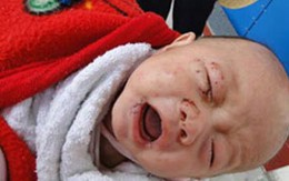 Bé 49 ngày tuổi bị chuột cắn đứt lìa môi