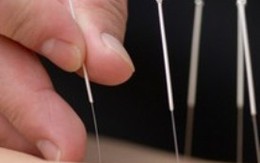 Rước thêm bệnh vì... châm cứu