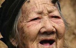 Cụ già có sừng trên trán sắp mọc thêm sừng mới
