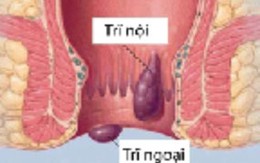 Bạn bị trĩ? Có cách đây!