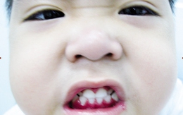 Phòng ngừa viêm nướu răng cho trẻ