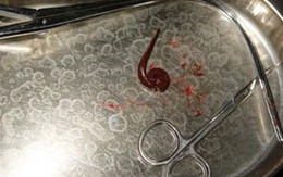 Con đỉa dài 3 cm chui vào phế quản người 