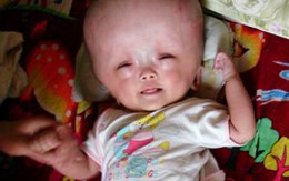 Bất lực nhìn con đau đớn vì bệnh đầu to