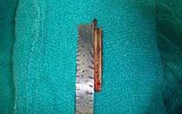 Mảnh gỗ 10 cm nằm trong não một cậu bé suốt 2 năm