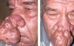 Người đàn ông có chiếc mũi voi kì dị