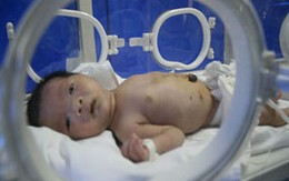 Cứu sống bé sơ sinh bị thủng ruột ngay trong bụng mẹ 
