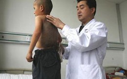 "Giải cứu" cho cậu bé đeo "mai rùa"