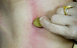 Cạo gió không đúng chỗ sẽ chết?