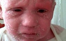 Bé trai gần 2 tuổi bị lột da quanh năm