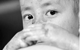 Bệnh lạ: Cởi quần áo là bong da