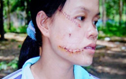 Ghen tuông, chồng nhẫn tâm rạch mặt vợ