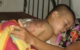 Ngã vào nồi nước chè xanh, bé trai bỏng nặng
