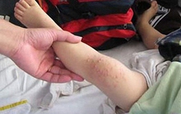 Viêm da tiếp xúc do côn trùng