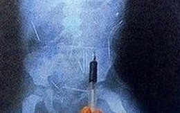 24 năm chung sống với 26 chiếc kim trong cơ thể